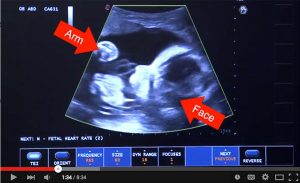 A clip from the new video "Looking at Life in the Womb," which focuses on ultrasound technology.